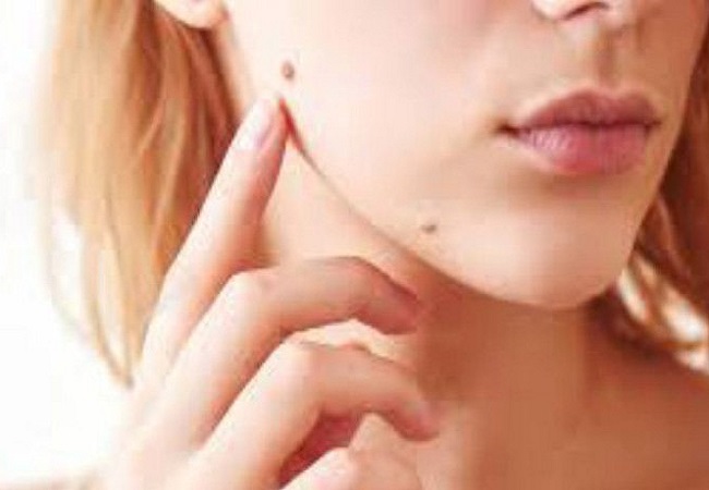 আঁচিল ঝরে পড়বে মাত্র ২ উপাদানে